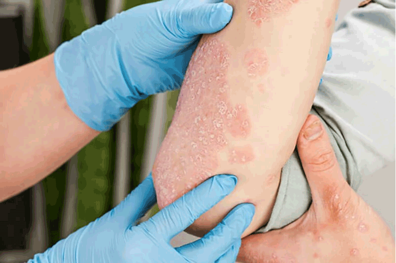 Understanding and Treatment of Psoriasis