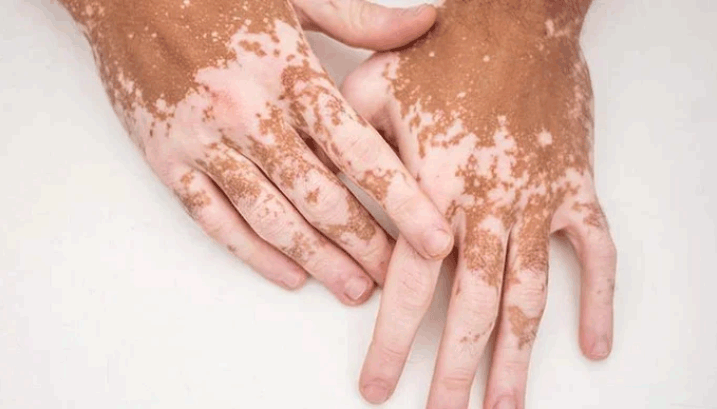 What is vitiligo?