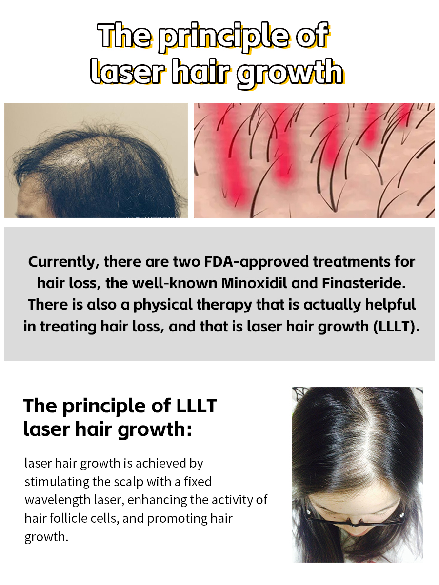  Save the Hairline! Laser hair growth caps, do they really work? 